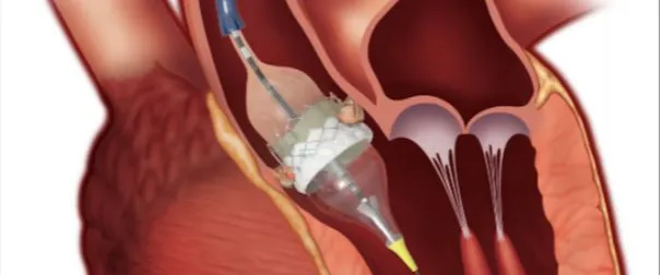 Minimally Invasive Aortic Valve Replacement
