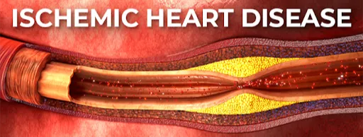 Evidenced Based Guidelines: Ischemic Heart Disease