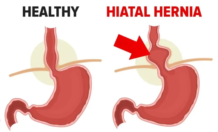 Hiatal Hernia Defects and the uses of Mesh Versus Human Grafts