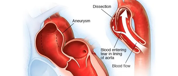 Immediate recognition of a dissecting Aorta