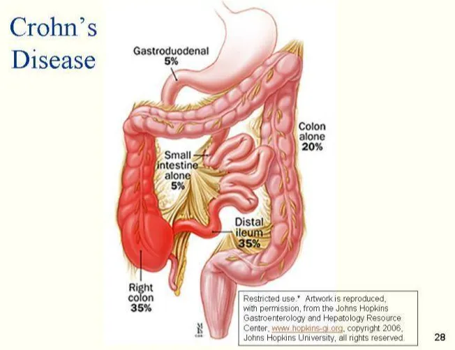 The Management of Crohn's Disease in Adults and Young People